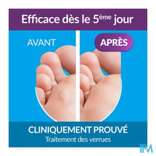 Afbeelding in Gallery-weergave laden, Excilor Wrattenbehandeling Duo Power 10ml+1,5g